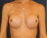 Feel Beautiful - Natural Breast Augmentation 013 - After Photo